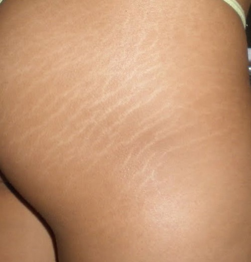 Tratamento das estrias