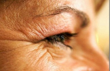 Alimentos e hábitos que geram rugas prematuras