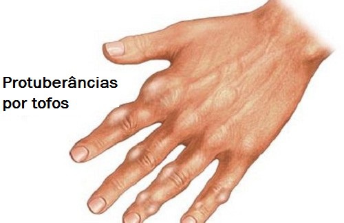 Acido úrico: como reduzir os níveis no sangue
