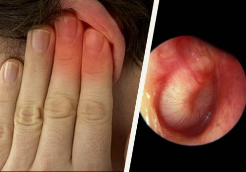 Inflamação no ouvido tampado