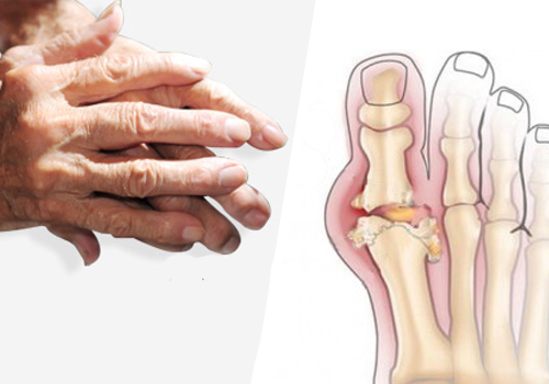 Recomendações para tratar a artrite