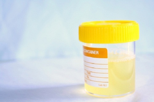 Como prevenir naturalmente as infecções urinárias?
