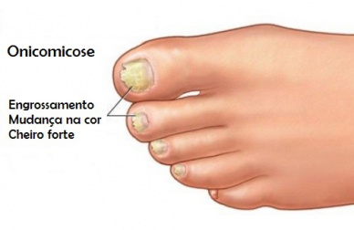 Onicomicose: quando os fungos estão nas unhas