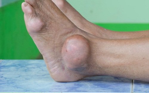 Ervas medicinais para tratar o ácido úrico