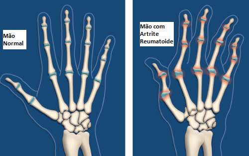 Óleo de rícino ajuda a previnir a artrite