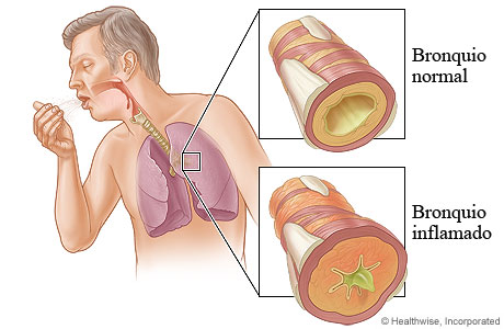 Limpeza de um brônquio inflamado
