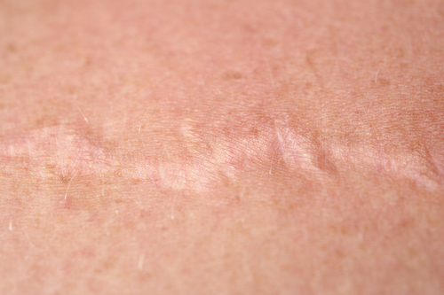 Cicatriz cebola na pele