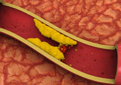 Como controlar o colesterol alto naturalmente?
