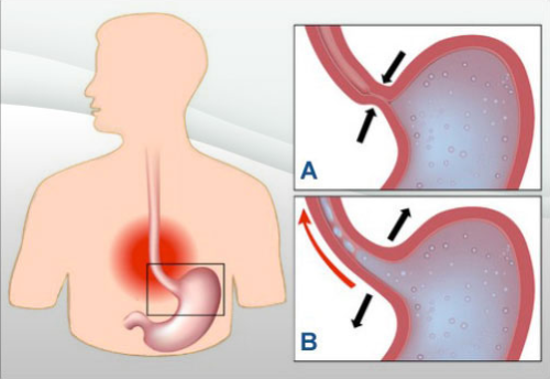 Como reduzir o refluxo