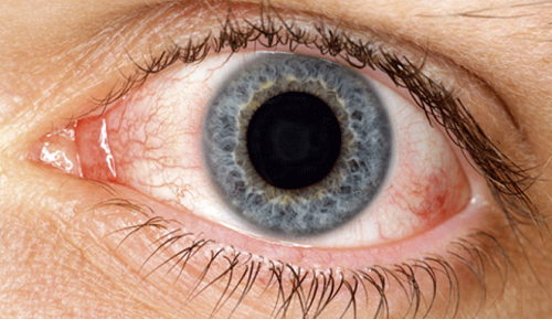 Remédios naturais para diminuir o ressecamento dos olhos