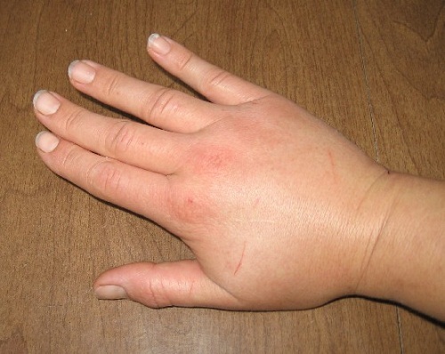 Retencao-de-liquidos