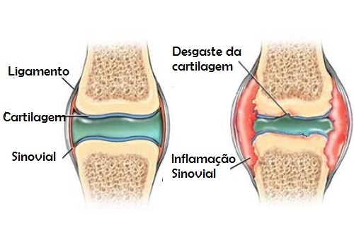 Como prevenir a dor nas cartilagens?