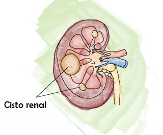 cisto renal