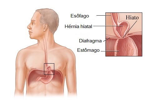 A hérnia de hiato tem cura?