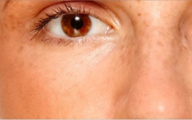 Cremes caseiros para Reduzir manchas na pele