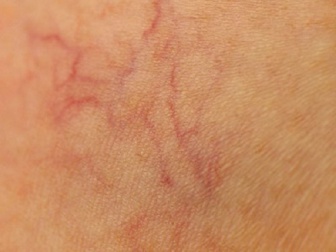 Nove dicas para prevenir os vasinhos naturalmente