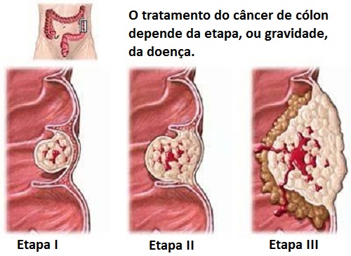 O que devemos saber sobre o câncer de cólon O que devemos saber sobre o câncer de cólon