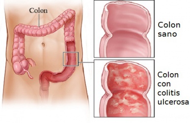 Tratamentos caseiros para a colite ulcerativa