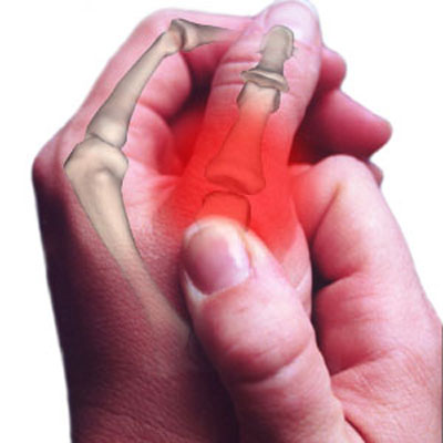 artrose-polegar