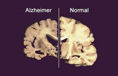 A falta de sono pode estar ligada ao Alzheimer