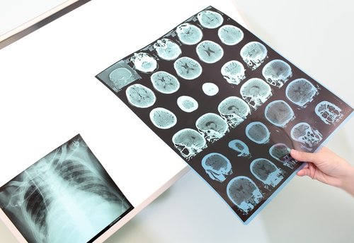 Incidência do Alzheimer