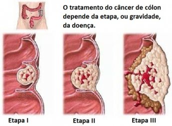 Câncer de cólon: tudo o que precisamos saber