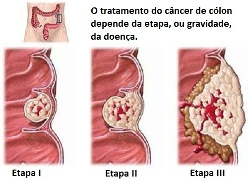 cancer de colon etapas y sintomas