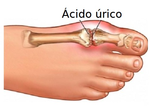Sinal do ácido úrico nos ossos
