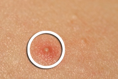 Tratamentos naturais para a acne