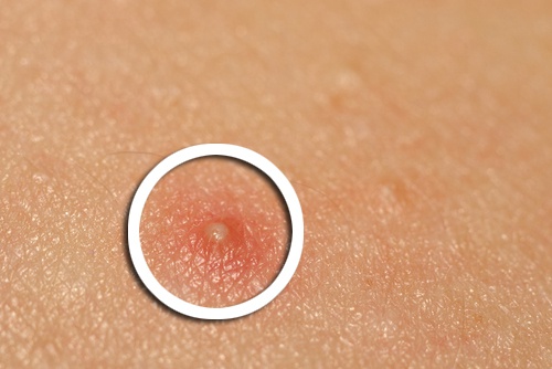 Tratamentos naturais para a acne
