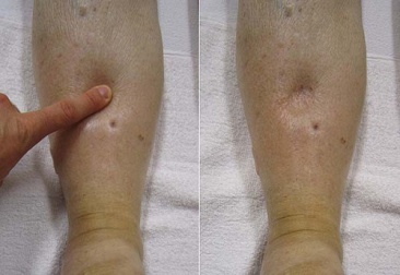 A hidropisia: conheça mais sobre esse problema