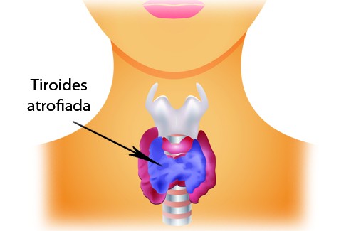 Hipotiroidismo-500x325