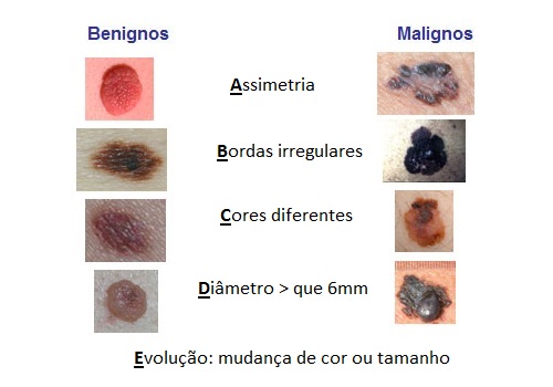 Melanomas