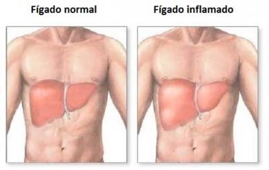 Como saber se seu fígado está inflamado?