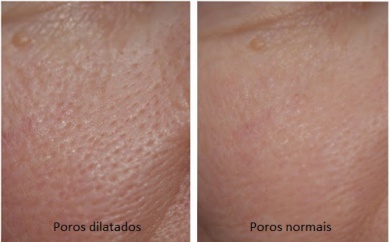 Poros dilatados? Experimente estas 3 máscaras