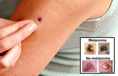 Sinais de alerta que indicam a presença de câncer de pele
