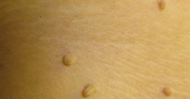 10 Remédios naturais para eliminar as verrugas do seu corpo