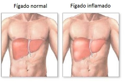 Fígado inflamado? Sintomas e dieta adequada