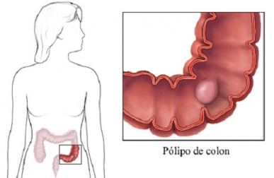 Pólipos intestinais: sintomas que você deve conhecer