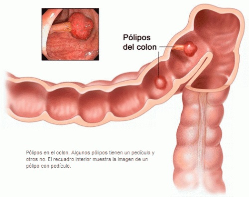 Pólipos intestinais