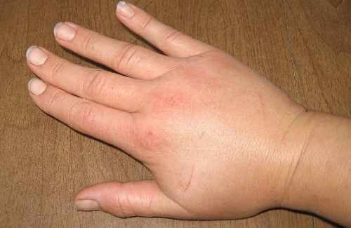 retenção de líquidos