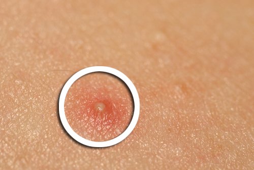 A acne nas mulheres pode aparecer na idade adulta