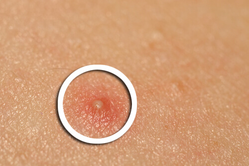 O vinagre de maçã ajuda a reduzir a acne