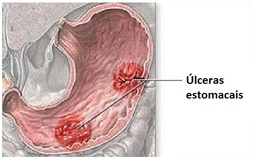Sintomas de uma úlcera no estômago