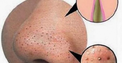 Como eliminar as espinhas e os cravos naturalmente?