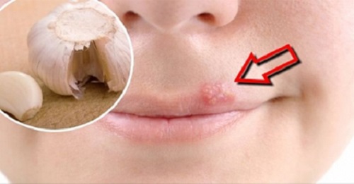 Herpes labial conheça remédios caseiros para alivio rápido