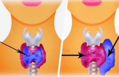Qual a diferença entre hipotireoidismo e hipertireoidismo?