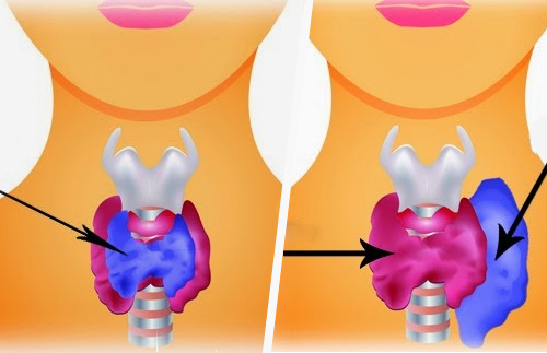 Como tratar a tireoide de maneira natural? Como tratar a tireoide de maneira natural?