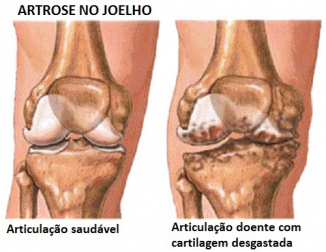Prevenção e sintomas da artrose