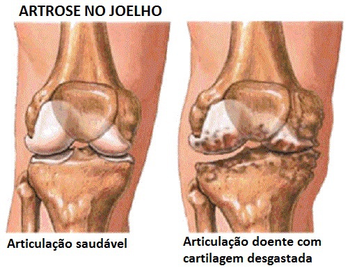 Prevenção e sintomas da artrose